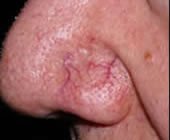 vein removal nose before pelham